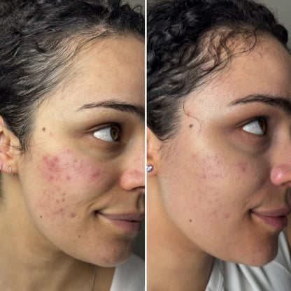 LED Light Therapy Face Mask